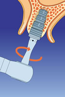 Implantatinsertion