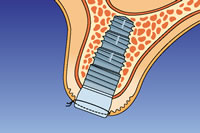 Implantatfreilegung