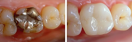 CEREC Restauration