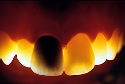 Metallkeramikkrone