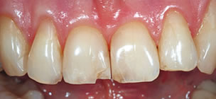 Veneers