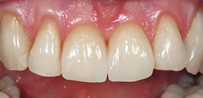 Veneers