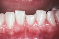 Veneers