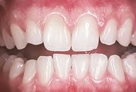 Veneers
