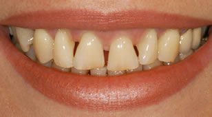 Veneers