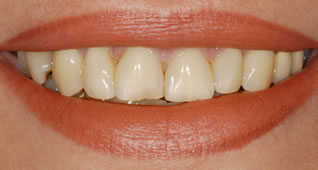 Veneers