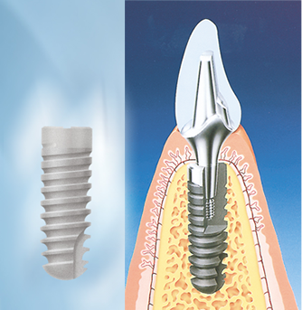 Was ist ein Implantat ?
