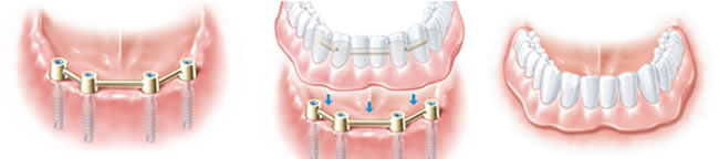 Steg, der die Implantate miteinander verbindet