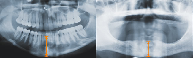 Regel immer gen&uuml;gen Knochen um ein Implantat zu verankern 