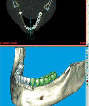 Implantate mit h&ouml;chster Pr&auml;zision
