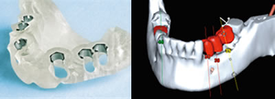 modernster Implantat-Technologie 