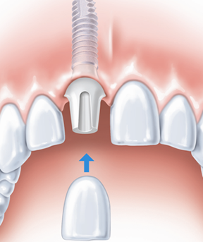Einheilungszeit von Implantaten