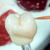 Dentallabor Elztal Einzelzahnbearbeitung