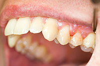 Gingivitis - Zahnfleischentzündung mit Zahnfleischbluten - Parodontologie Heidelberg